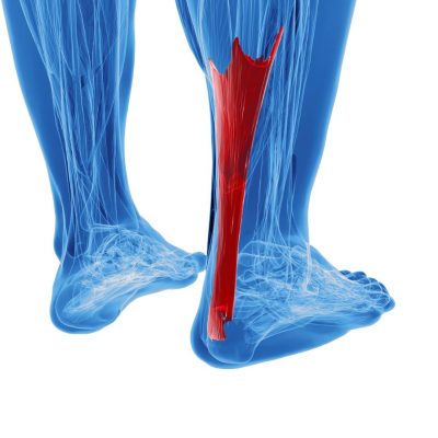 Do you have calf pain (Achilles Tendinosis)? Then TM Physio can help!